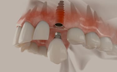 安心・安全インプラント