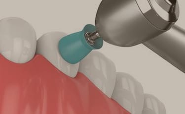 痛みのないクリーニング