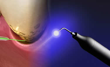 ブルーラジカル